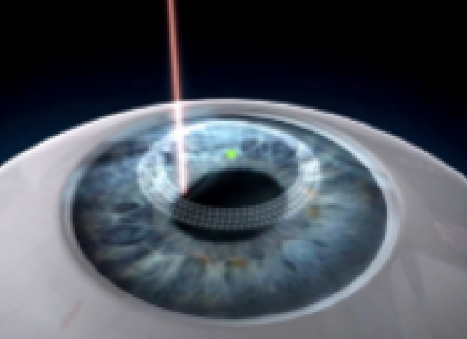 비쥬맥스라식 수술방법