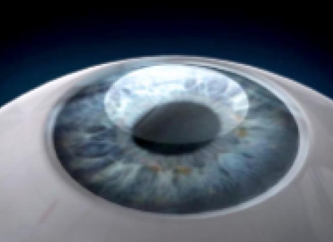 비쥬맥스라식 수술방법