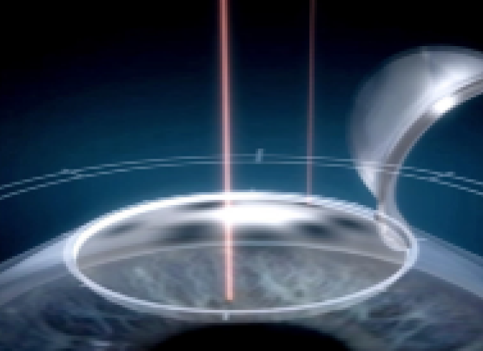 비쥬맥스라식 수술방법