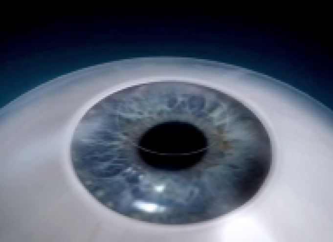 비쥬맥스라식 수술방법